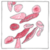 Illustration of Sickle-cell disease